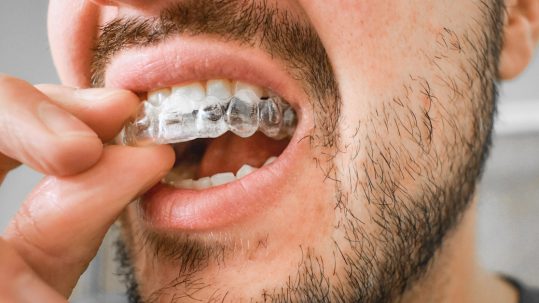 basingstoke teeth straightening