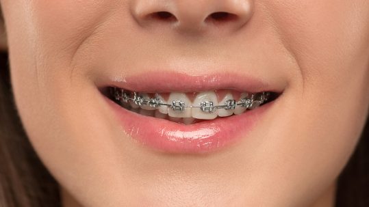 Improve breathing and speaking with orthodontic treatments basignstoke