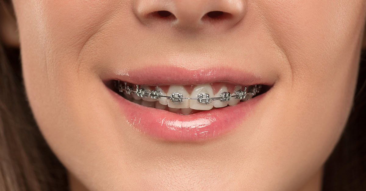 Improve breathing and speaking with orthodontic treatments basignstoke